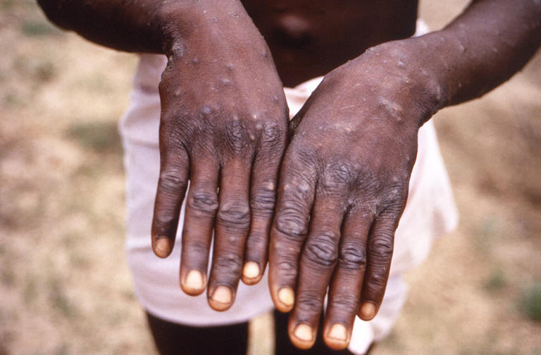 Côte d'Ivoire: 28 cas de mpox recensés dont un décès