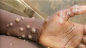 Mpox : l’OIM recherche plus de 11 milliards FCFA pour renforcer la riposte en Afrique de l’Est et Australe