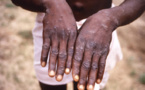 Côte d'Ivoire: 28 cas de mpox recensés dont un décès
