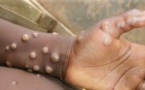 Mpox : l’OIM recherche plus de 11 milliards FCFA pour renforcer la riposte en Afrique de l’Est et Australe